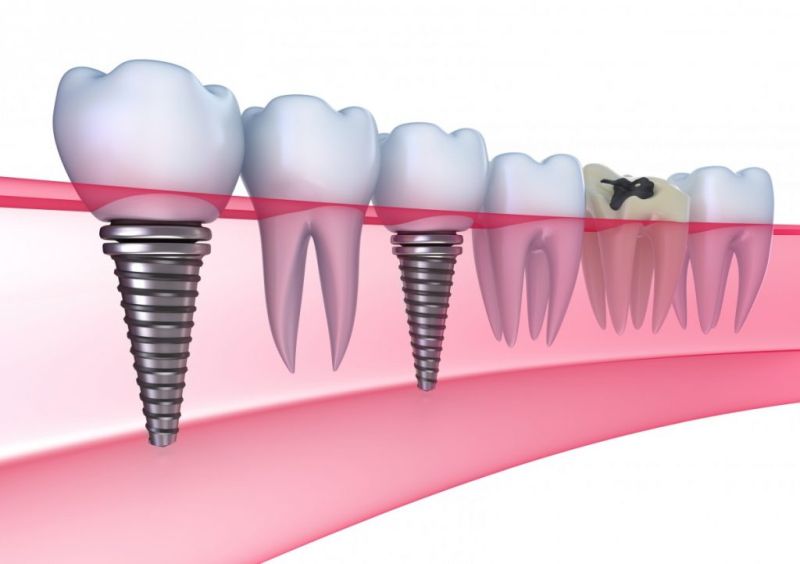 implant-dentar